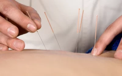 Acupuncture or Dry Needle: What Is It? What Is It Used For?