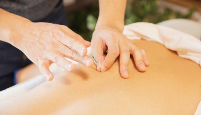 Dry Needling